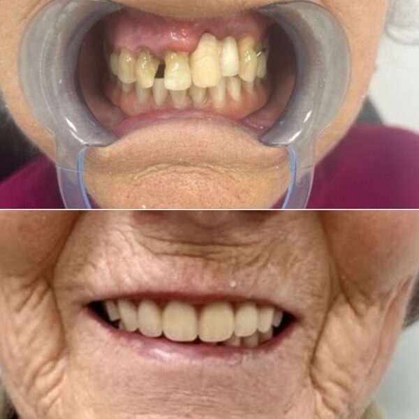 Implantes clinica dental Nuovadente 2 600x600