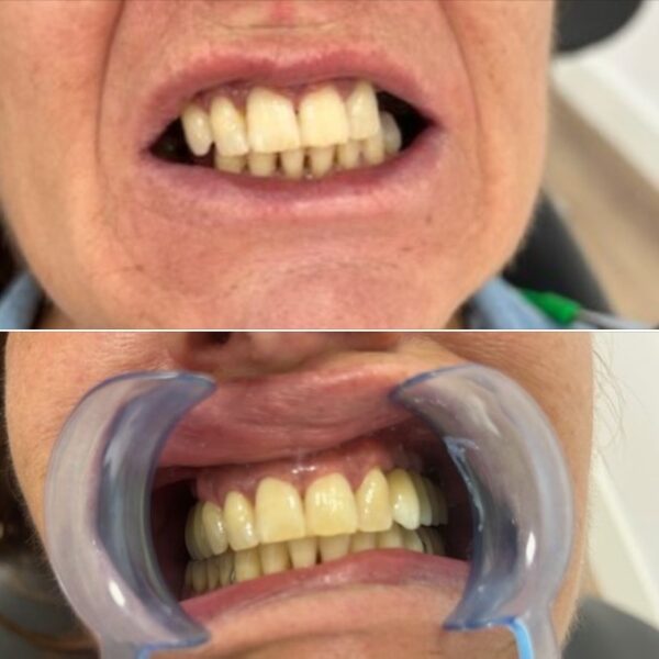 Implantes clinica dental Nuovadente 3 600x600
