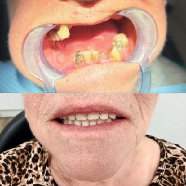 Implantes clinica dental Nuovadente 4 600x600