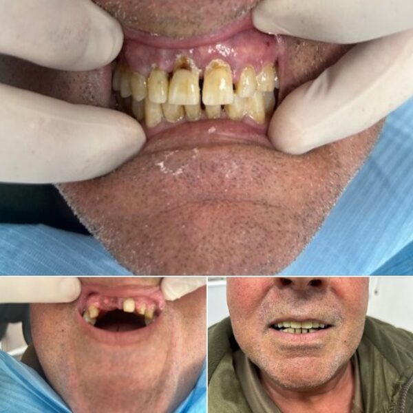 Implantes clinica dental Nuovadente 7 600x600