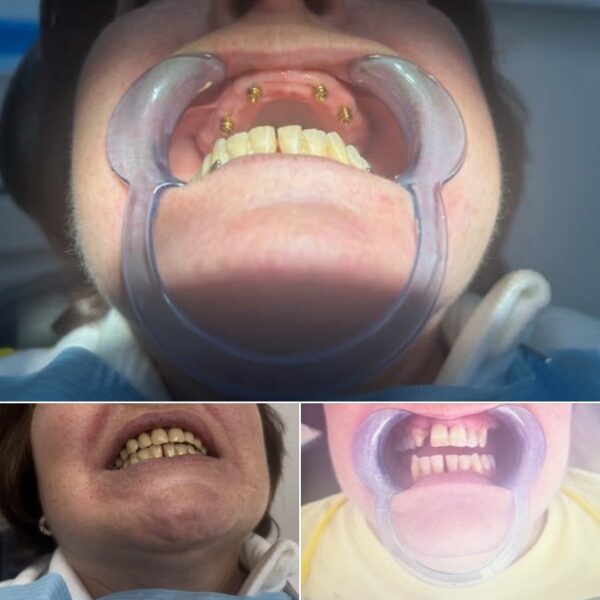 Implantes clinica dental Nuovadente 8 600x600